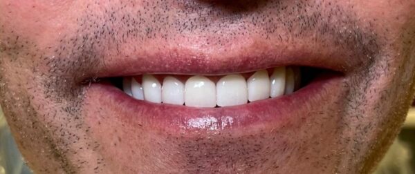 After