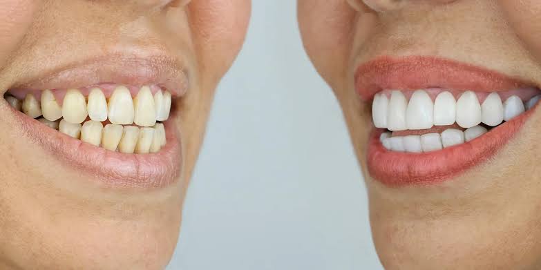 Cosmetic Crowns